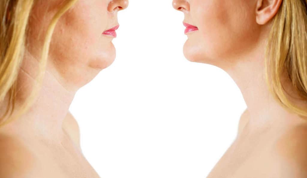 Double Chin treatment Greater London (Haringey) before and after results