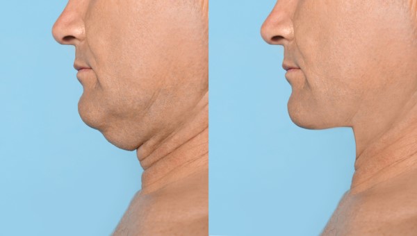 Which Non-Surgical Treatments Work Best for Jowls and Loose Skin Greater London (Haringey)?