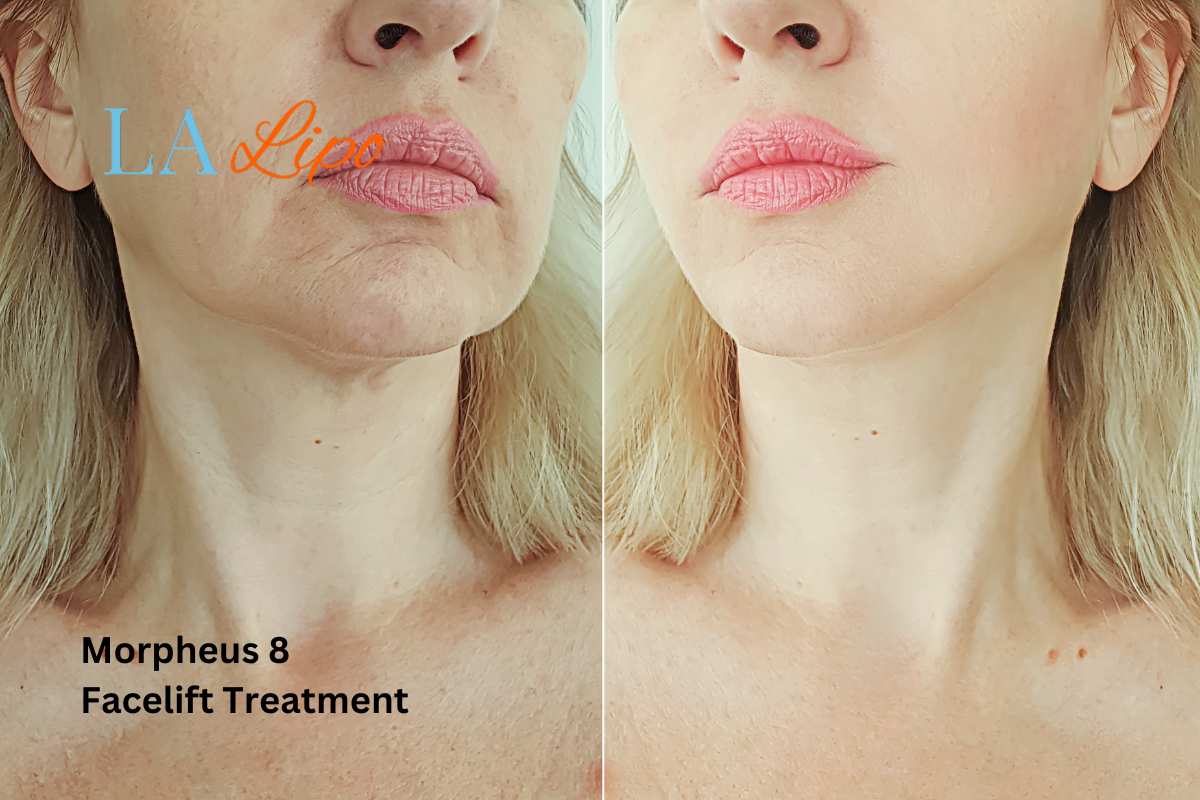 Turn back time with Morpheus8 Treatment Greater London (Haringey)