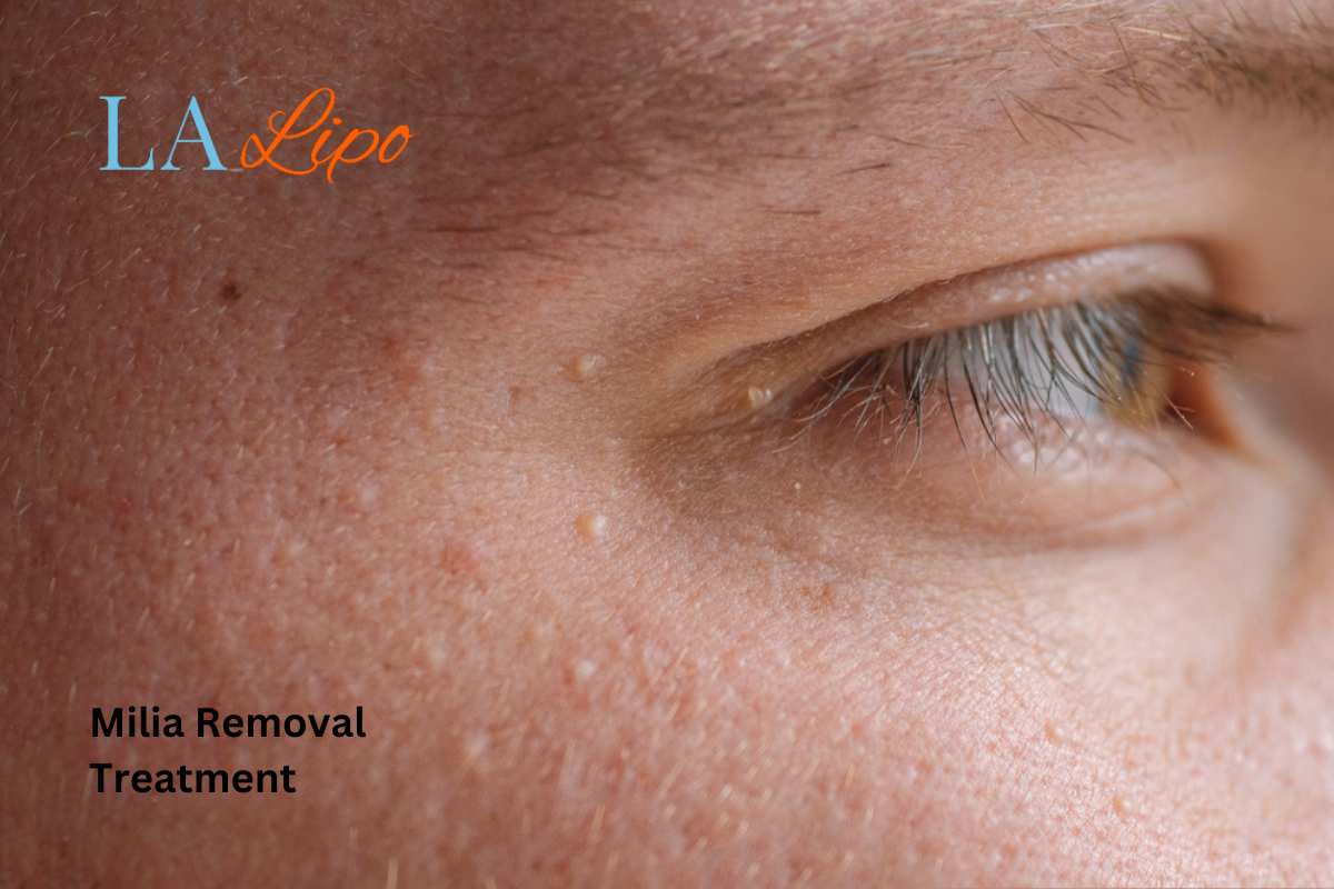 Cryopen Milia Removal: Is It the Easiest and Safest Option Greater London (Haringey)?