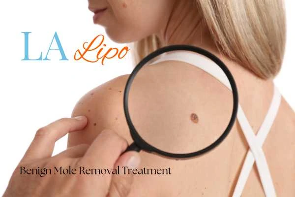 Woman having her inspection of blemish before mole removal Greater London (Haringey)