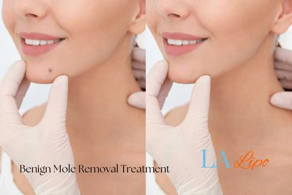 woman's before and after mole removal Greater London (Haringey) results