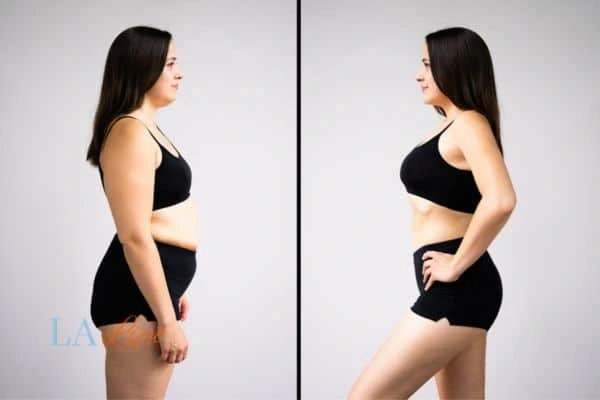 image of woman before and after results of LA-EMS Body Sculpting Greater London (Haringey) to help treat Diastasis recti