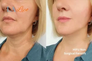 hi-fu for wrinkles Greater London (Haringey) before and after results