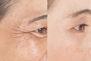 Before and after results of woman - HI-fu wrinkles reduction treatment Greater London (Haringey)