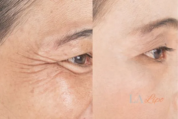 Before and after results of woman - HI-fu wrinkles reduction treatment Greater London (Haringey)
