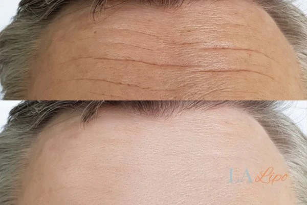 results of HIFU Greater London (Haringey) on mans forehead to help reduce lines and wrinkles