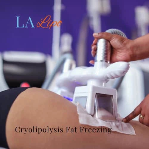 fat freezing - Cryolipolysis Greater London (Haringey)