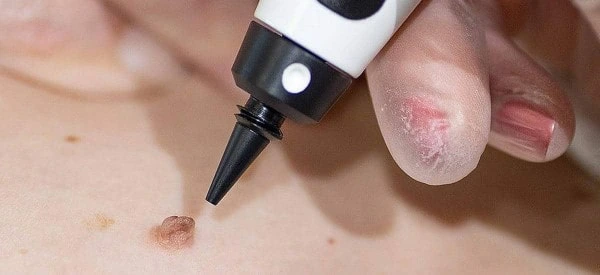 skin tag removal using cryopen Greater London (Haringey)