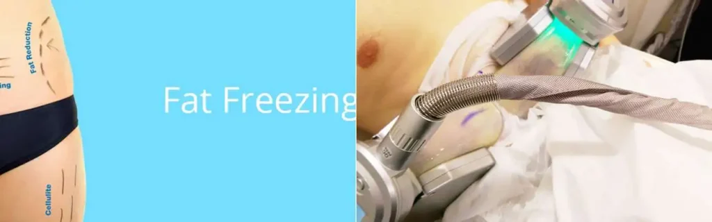 Fat freezing Greater London (Haringey) on multiple areas of the body