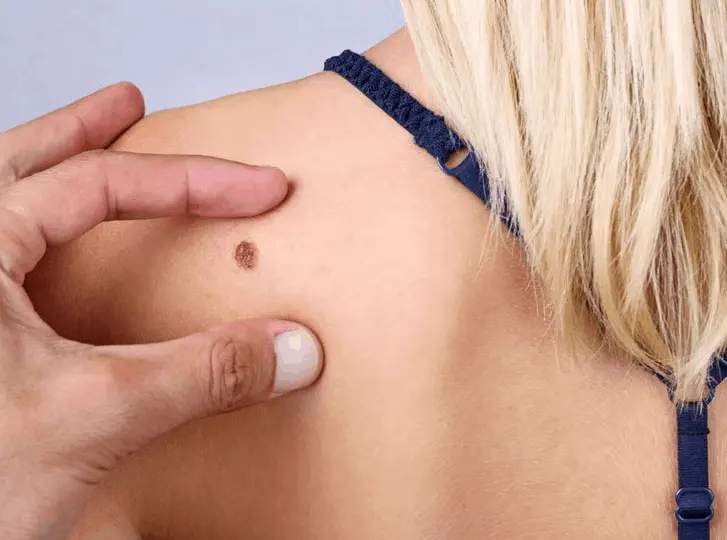 woman having mole removal Greater London (Haringey) consultation before treatment.