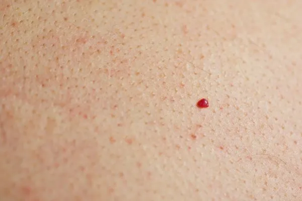 close up of a cherry angioma Greater London (Haringey)
