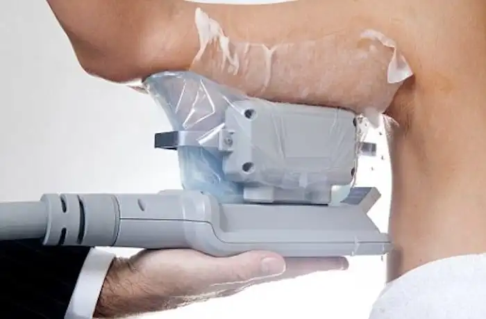 Picture of fat freezing Greater London (Haringey) on the upper arms.