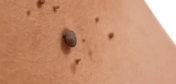 image of a skin tag Greater London (Haringey)