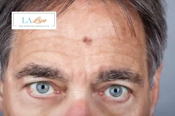 Solar Lentigo Removal Greater London (Haringey) image of man with mark on his forehead