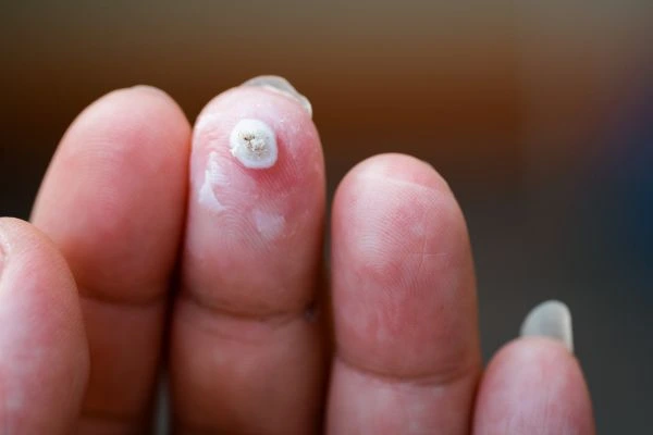 wart on person finger - cryotherapy to treat from LA LIPO Greater London (Haringey)