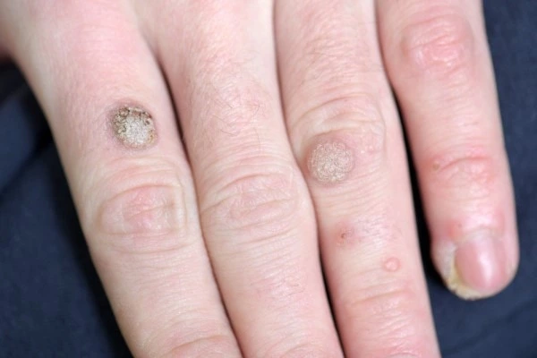 photo of warts on person hand - see wart removal Greater London (Haringey) from LA LIPO
