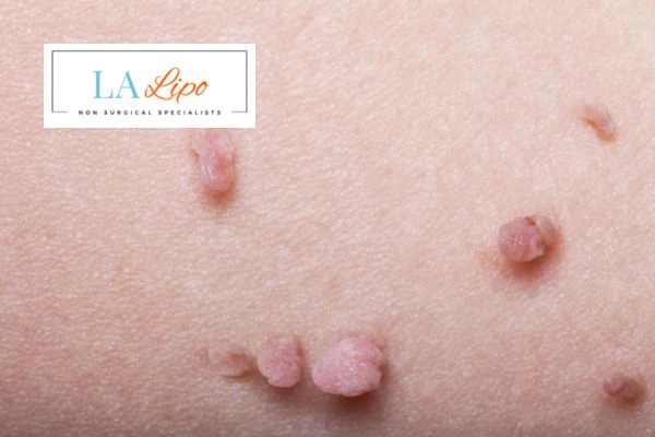 Does cryopen skin tag removal Greater London (Haringey) hurt? Find out now call our team today!