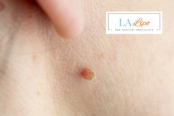 Book skin tag removal Greater London (Haringey) today speak to our team now!