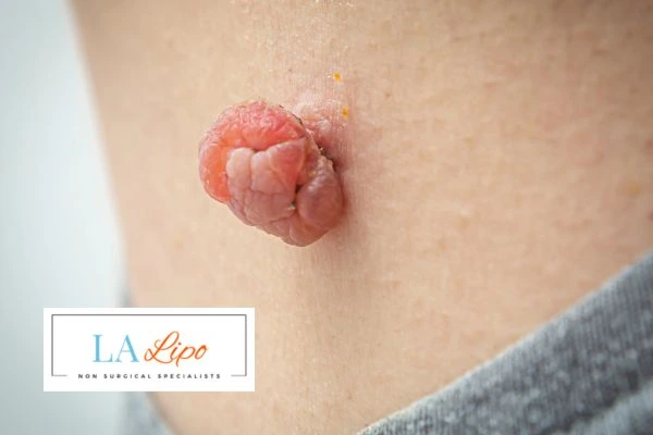 Interested in skin tag removal Greater London (Haringey)? Concerned about the pain? Find out more today!