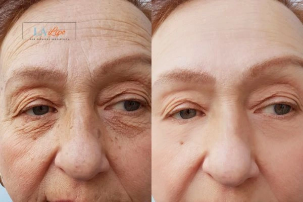 The powerful benefits of Morpheus8 Treatment Greater London (Haringey) - Call Our team today!