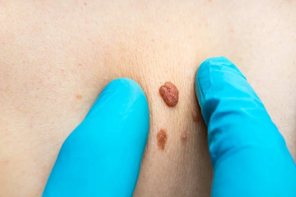 LA LIPO Cryopen Lesion Removal Prices Greater London (Haringey)