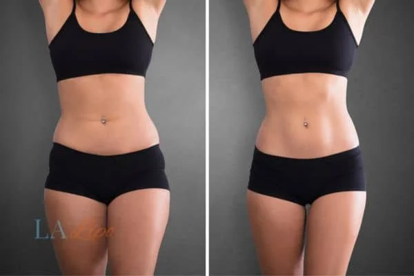before and after results of non-surgical treatment to help a woman's body image and mental health Greater London (Haringey)