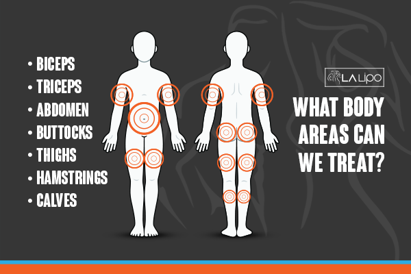 Diagram to show areas you can have LA-EMS Body Sculpting Treatment Greater London (Haringey)