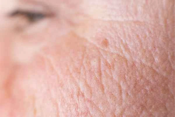 close up picture of a woman's face showing an age spot Greater London (Haringey)