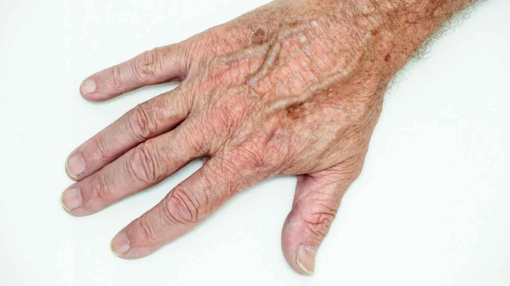 Male hand showing age spot Greater London (Haringey)