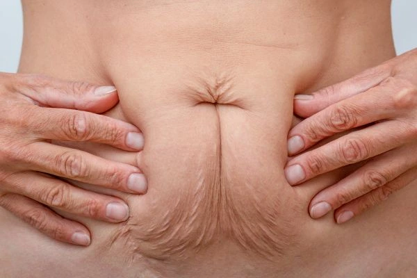 Image of a woman's stomach with loose skin - example of skin tightening Greater London (Haringey) options