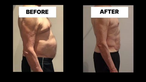 What Symptoms Can Diastasis Recti Cause in Men? Weak Core, Back Pain and Poor Posture Greater London (Haringey)